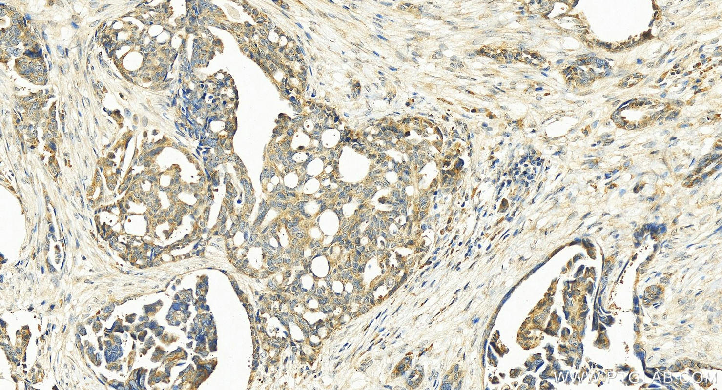 Immunohistochemistry (IHC) staining of human ovary cancer tissue using LARP1 Polyclonal antibody (13708-1-AP)