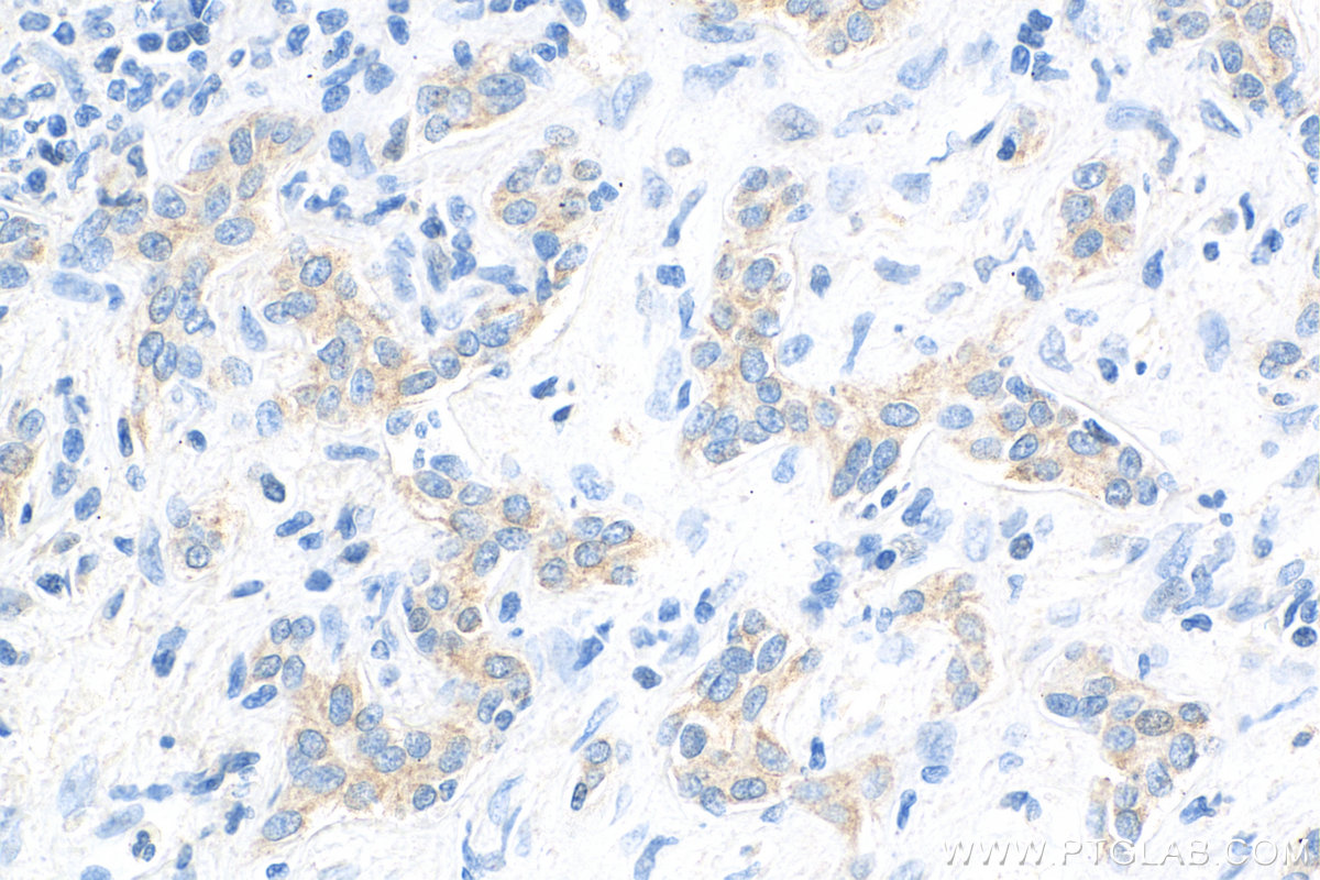 Immunohistochemistry (IHC) staining of human liver cancer tissue using LASP1 Monoclonal antibody (68080-1-Ig)