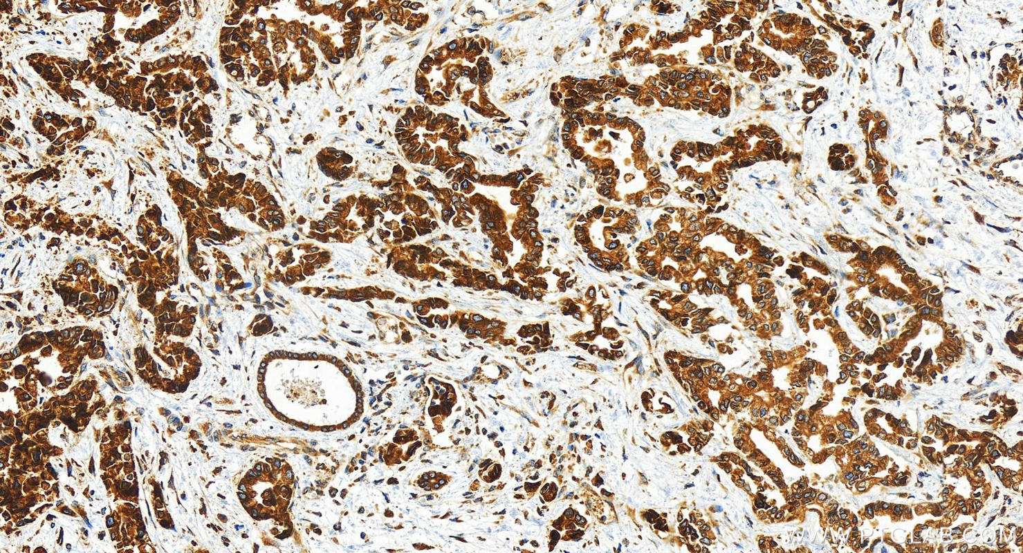 Immunohistochemistry (IHC) staining of human intrahepatic cholangiocarcinoma tissue using LASS2 Polyclonal antibody (30183-1-AP)