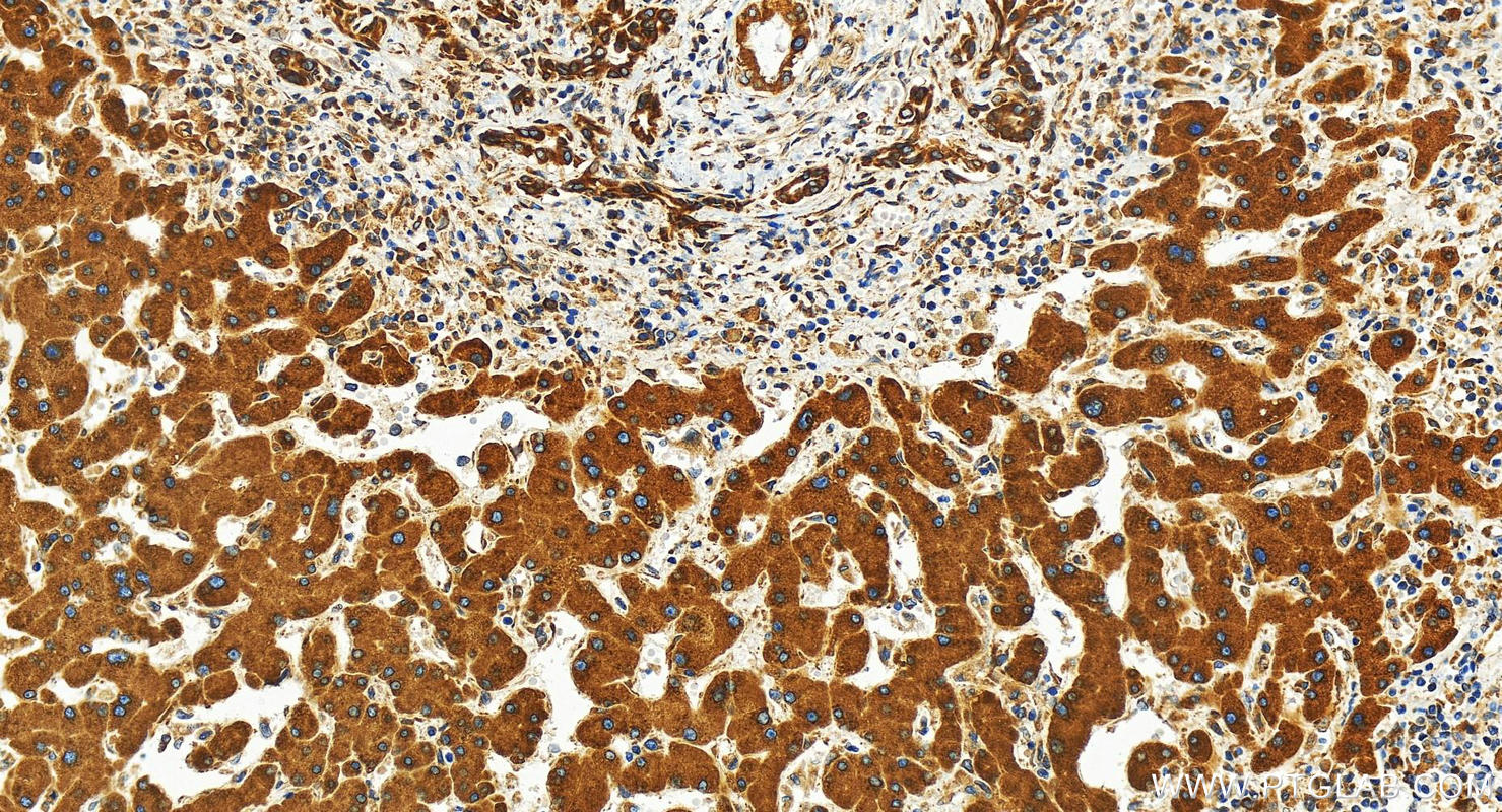 Immunohistochemistry (IHC) staining of human intrahepatic cholangiocarcinoma tissue using LASS2 Polyclonal antibody (30183-1-AP)