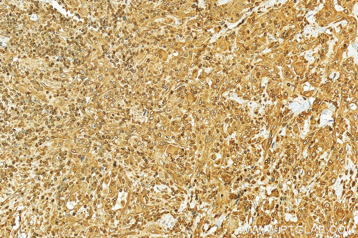 Immunohistochemistry (IHC) staining of human skin cancer tissue using LBR Polyclonal antibody (12398-1-AP)