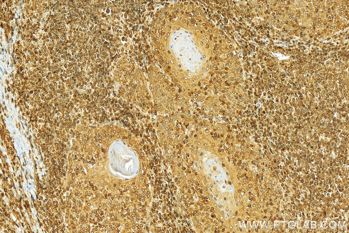 Immunohistochemistry (IHC) staining of human skin cancer tissue using LBR Polyclonal antibody (12398-1-AP)