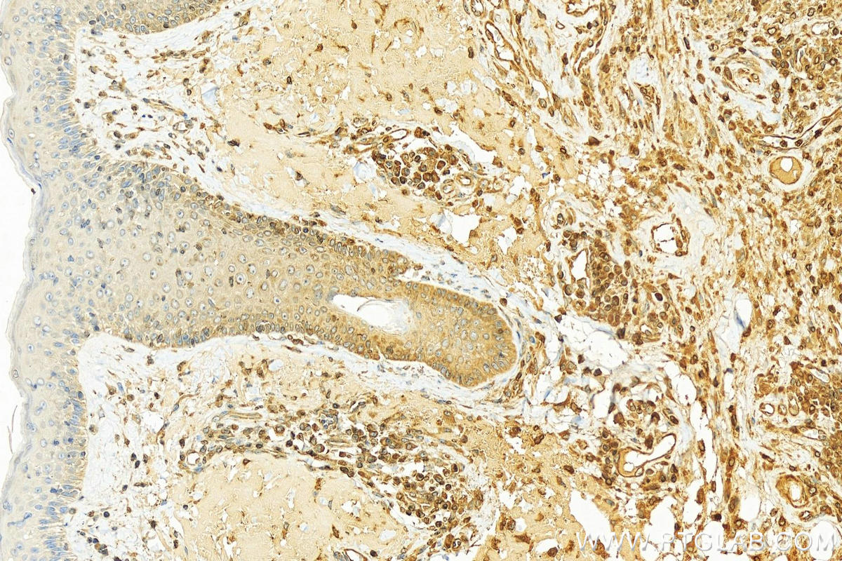 Immunohistochemistry (IHC) staining of human skin cancer tissue using LBR Polyclonal antibody (12398-1-AP)