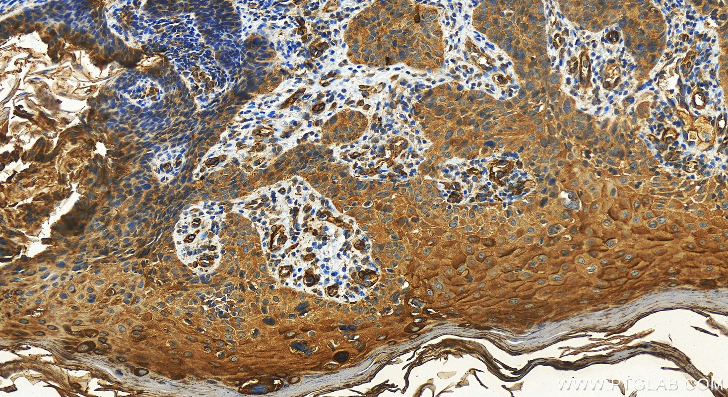 Immunohistochemistry (IHC) staining of Human bowens disease using NGAL Polyclonal antibody (30700-1-AP)