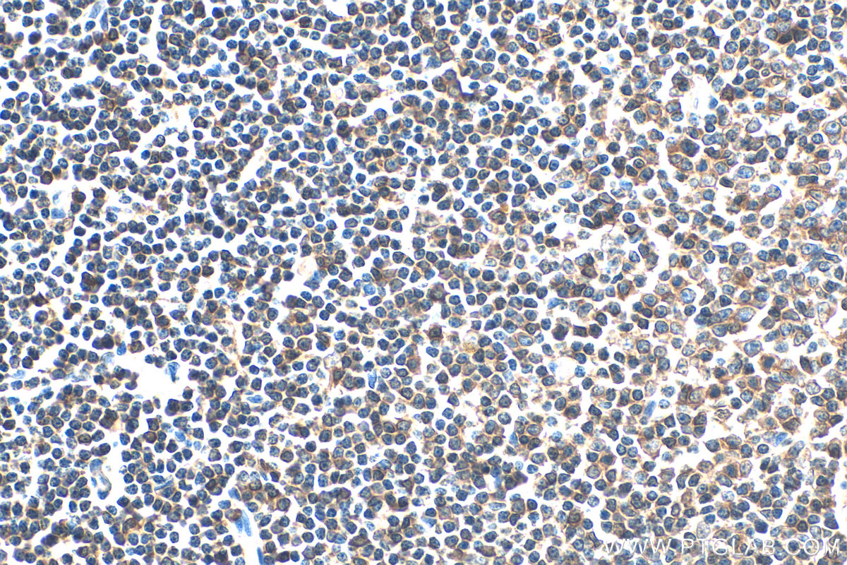 Immunohistochemistry (IHC) staining of human lymphoma tissue using L-Plastin Polyclonal antibody (13025-1-AP)