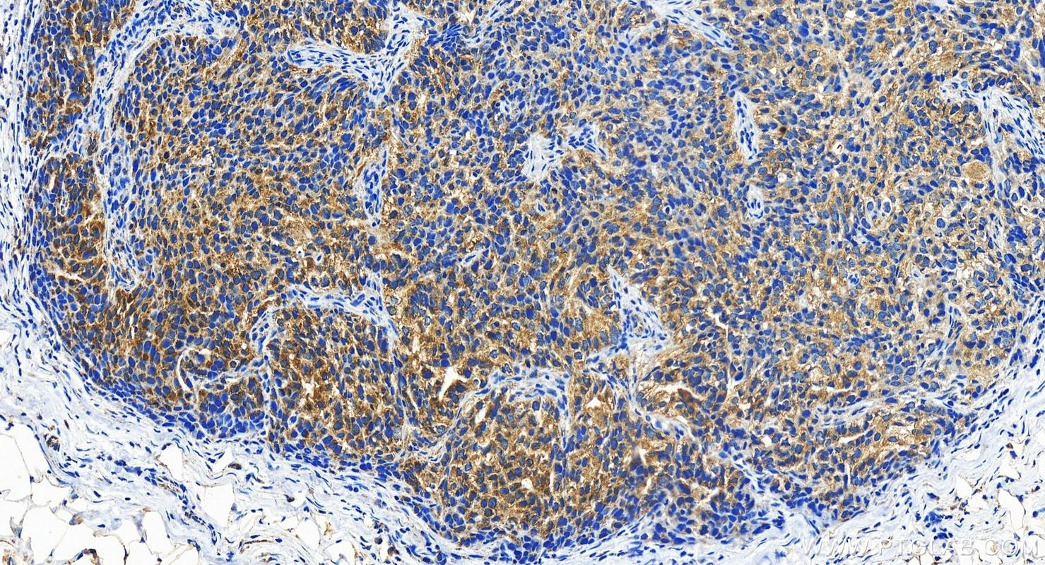 Immunohistochemistry (IHC) staining of human ovary cancer tissue using LDHB-Specific Polyclonal antibody (19988-1-AP)