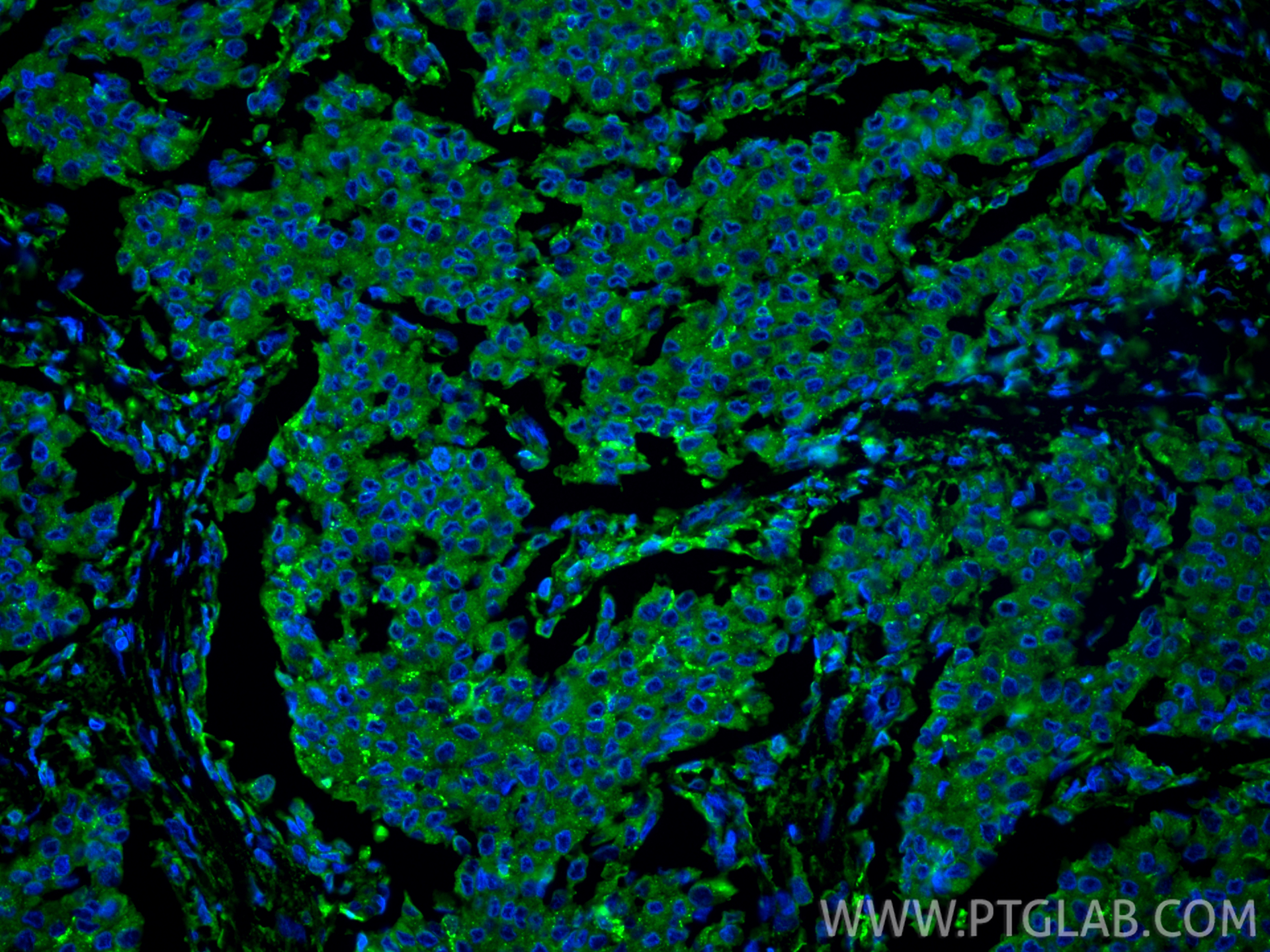 Immunofluorescence (IF) / fluorescent staining of human breast cancer tissue using LGALS3BP Monoclonal antibody (60066-1-Ig)