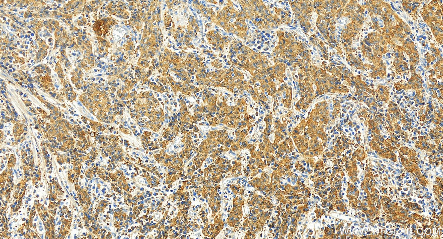 Immunohistochemistry (IHC) staining of human stomach cancer tissue using Galectin-4 Polyclonal antibody (27552-1-AP)