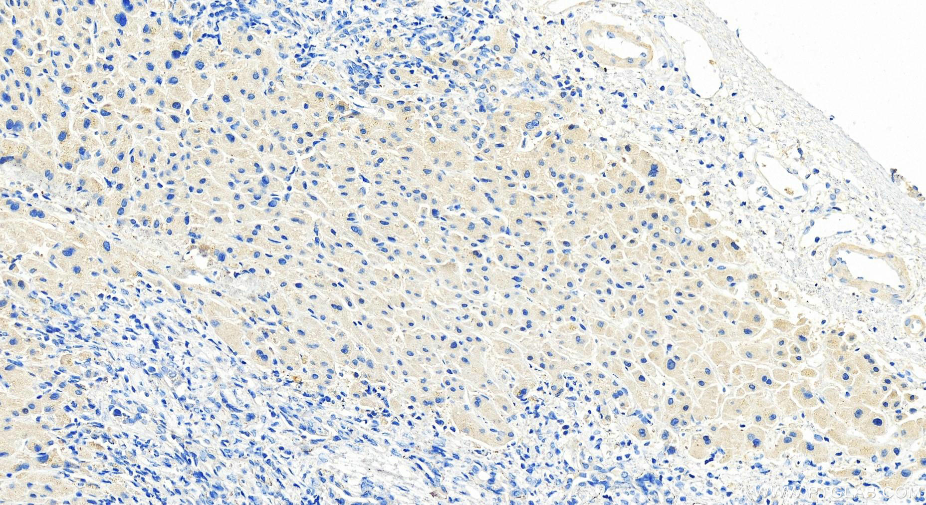 Immunohistochemistry (IHC) staining of human intrahepatic cholangiocarcinoma tissue using Galectin 8 Polyclonal antibody (10955-1-AP)