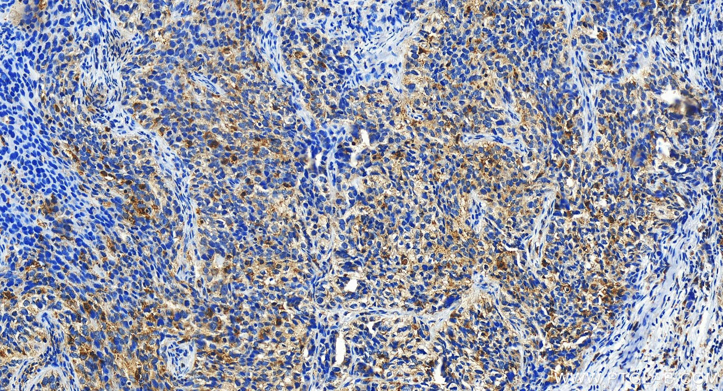 Immunohistochemistry (IHC) staining of human ovary cancer tissue using LGALS9/Galectin-9 Polyclonal antibody (17938-1-AP)