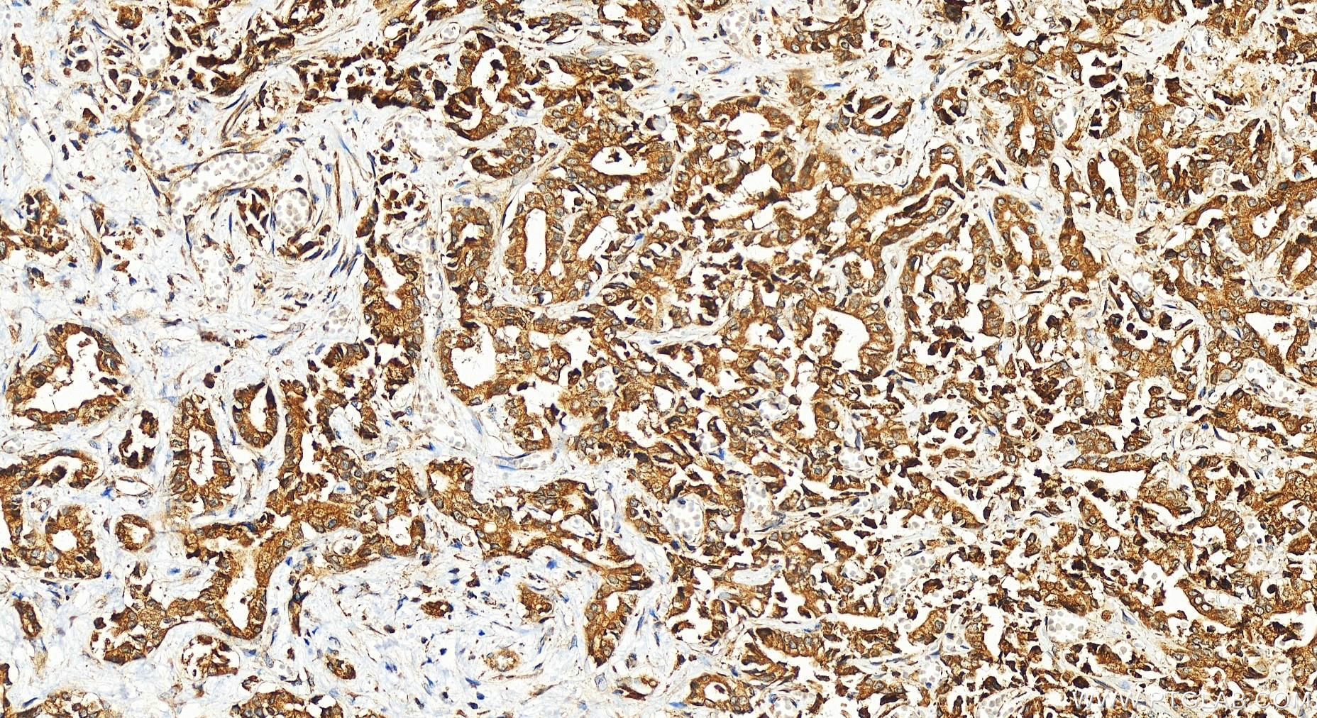 Immunohistochemistry (IHC) staining of human intrahepatic cholangiocarcinoma tissue using LGTN Polyclonal antibody (12840-1-AP)