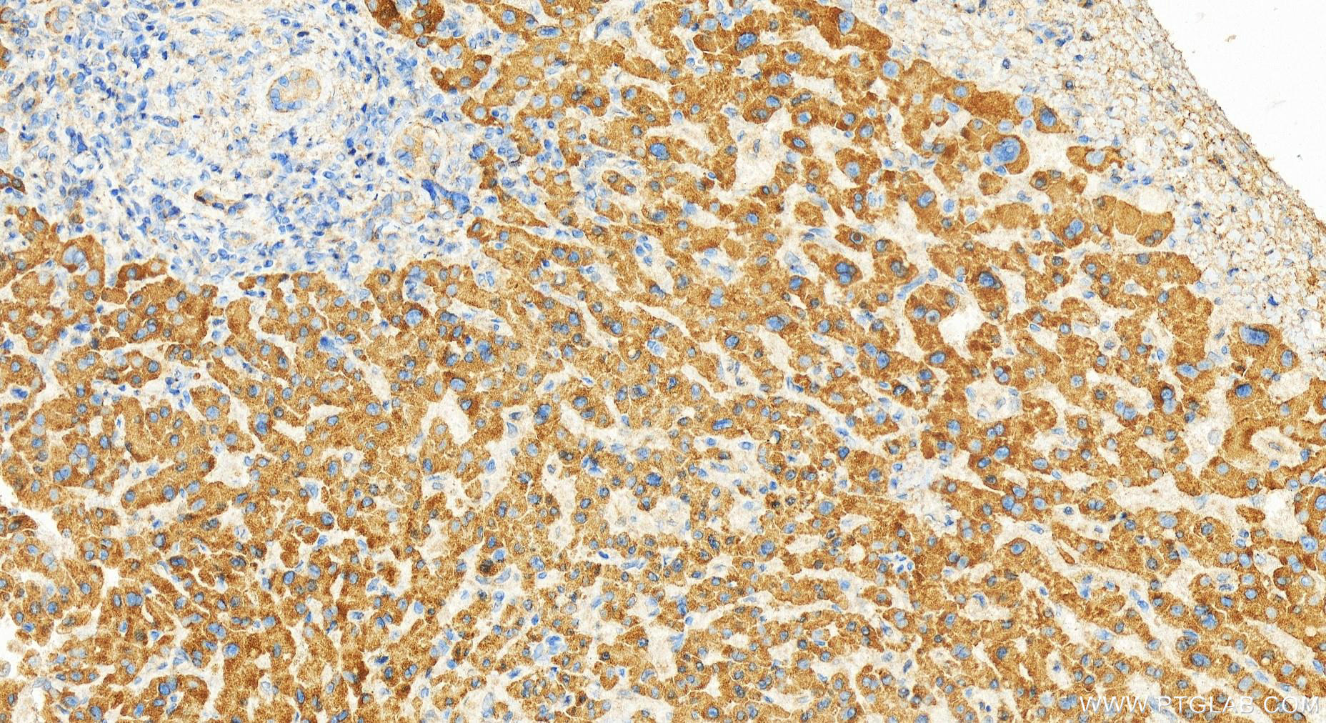 Immunohistochemistry (IHC) staining of human intrahepatic cholangiocarcinoma tissue using LGTN Polyclonal antibody (12840-1-AP)