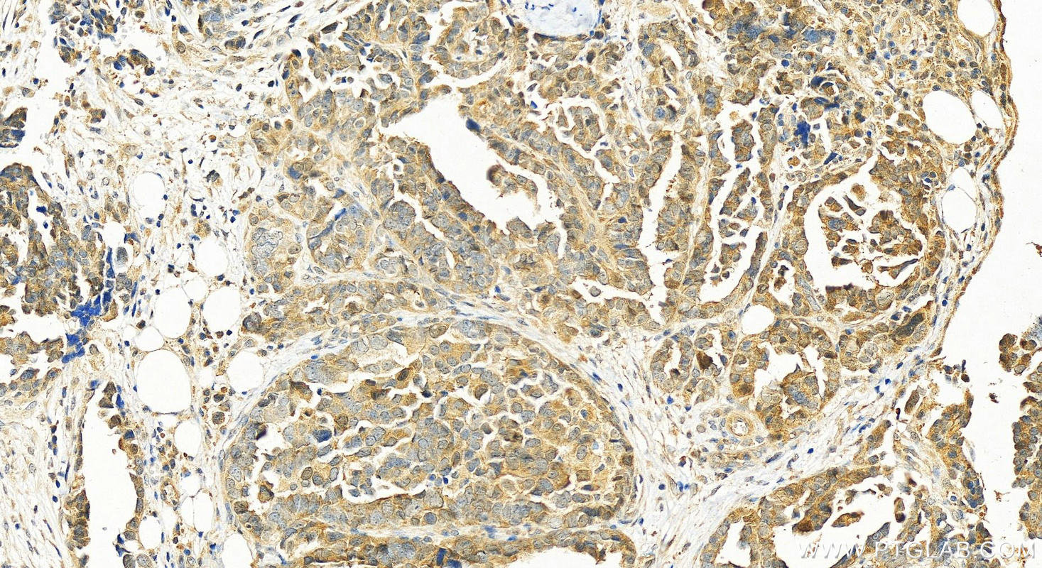 Immunohistochemistry (IHC) staining of human ovary cancer tissue using LHCGR Polyclonal antibody (26424-1-AP)