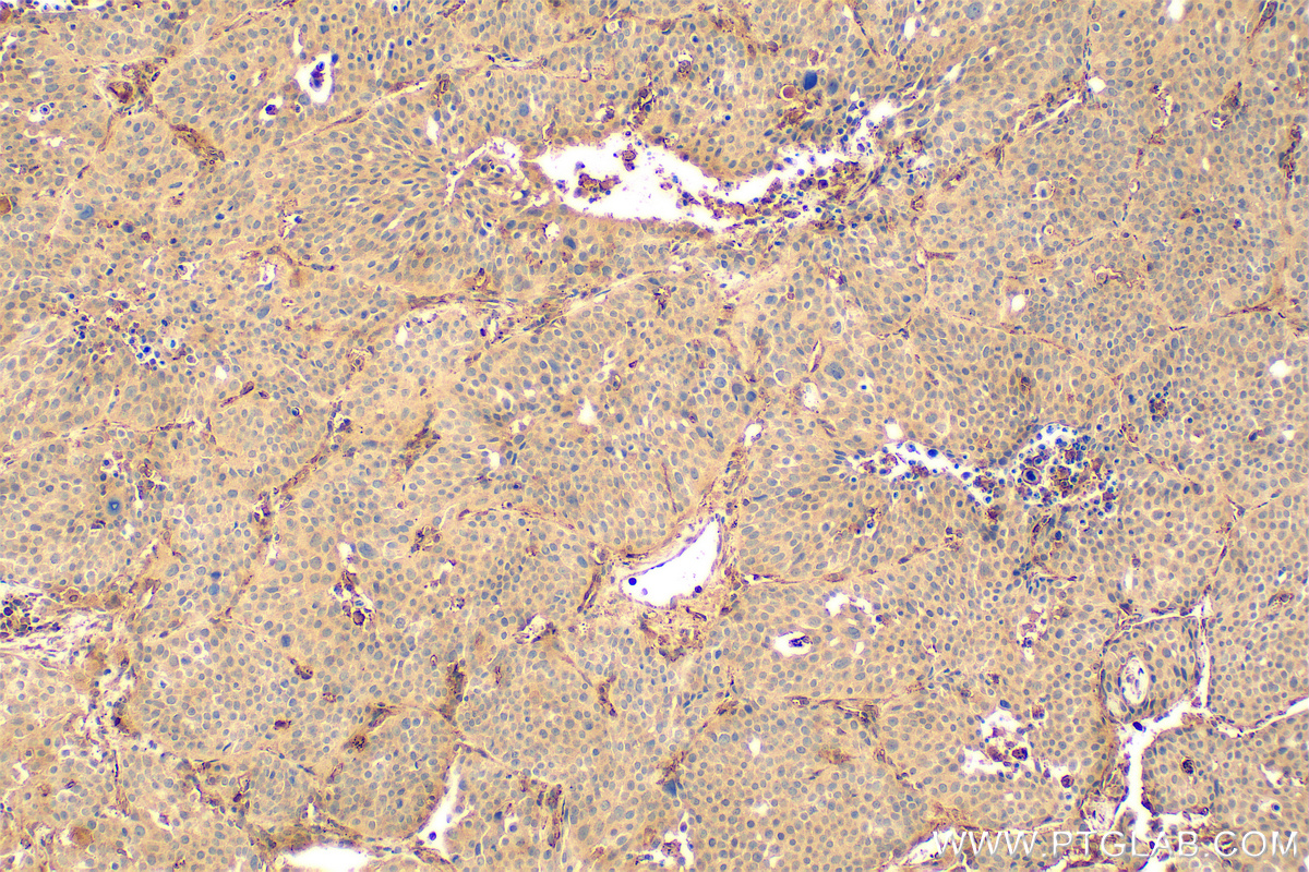 Immunohistochemistry (IHC) staining of human lung cancer tissue using LIF Polyclonal antibody (26757-1-AP)