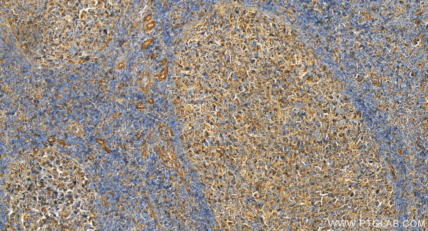 Immunohistochemistry (IHC) staining of human tonsillitis tissue using LILRA2 Polyclonal antibody (11461-1-AP)