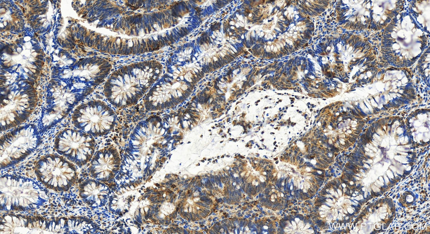 Immunohistochemistry (IHC) staining of human colon cancer tissue using LIPA Polyclonal antibody (12956-1-AP)