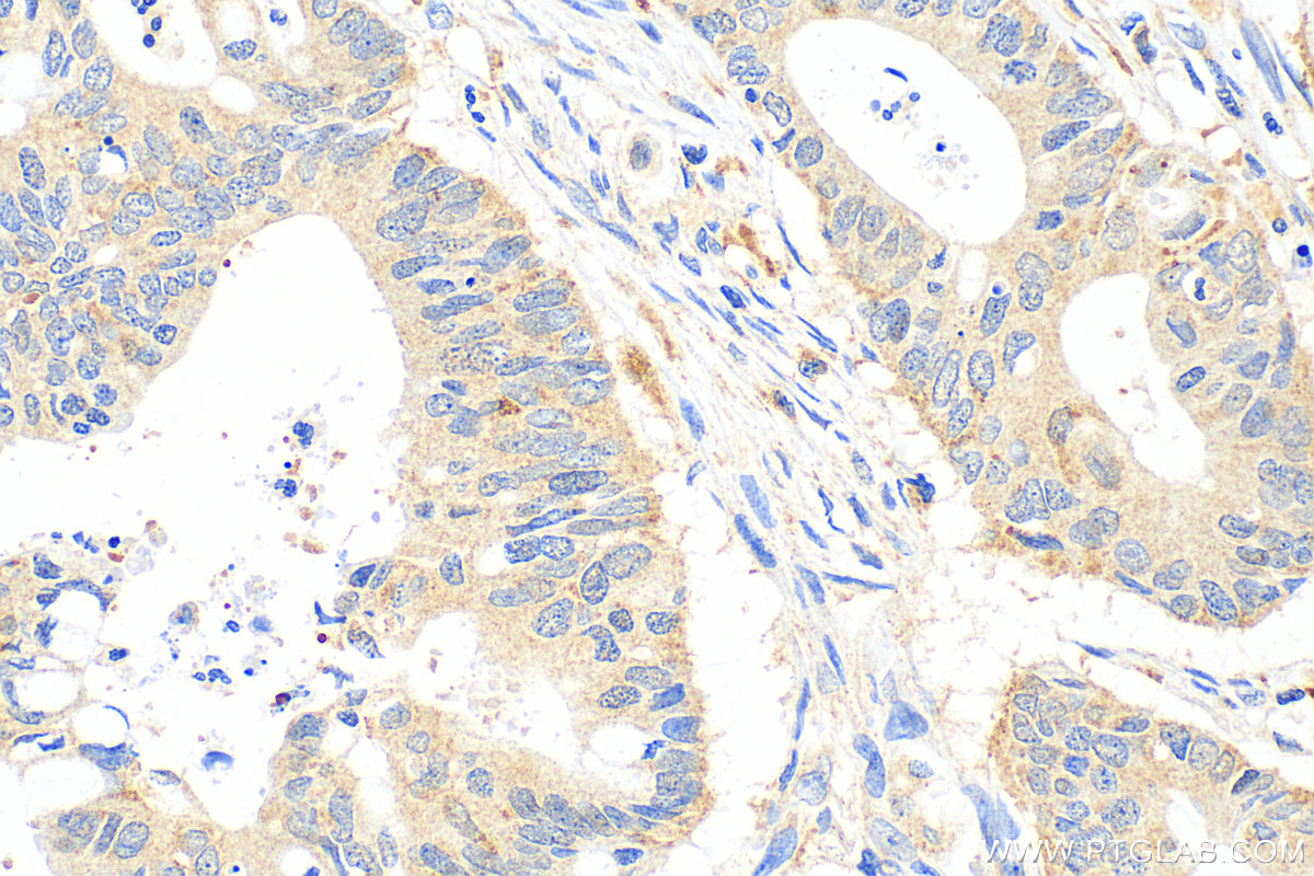 Immunohistochemistry (IHC) staining of human colon cancer tissue using LIPA Polyclonal antibody (12956-1-AP)