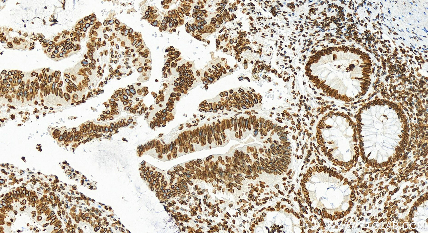 Immunohistochemistry (IHC) staining of human colon cancer tissue using Lamin B1 Polyclonal antibody (12987-1-AP)