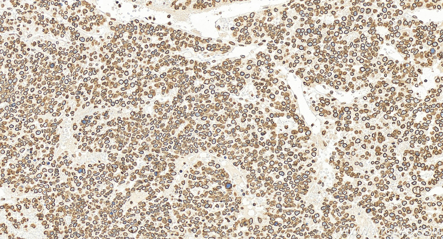 Immunohistochemistry (IHC) staining of human hepatocellular carcinoma using Lamin B1 Polyclonal antibody (12987-1-AP)