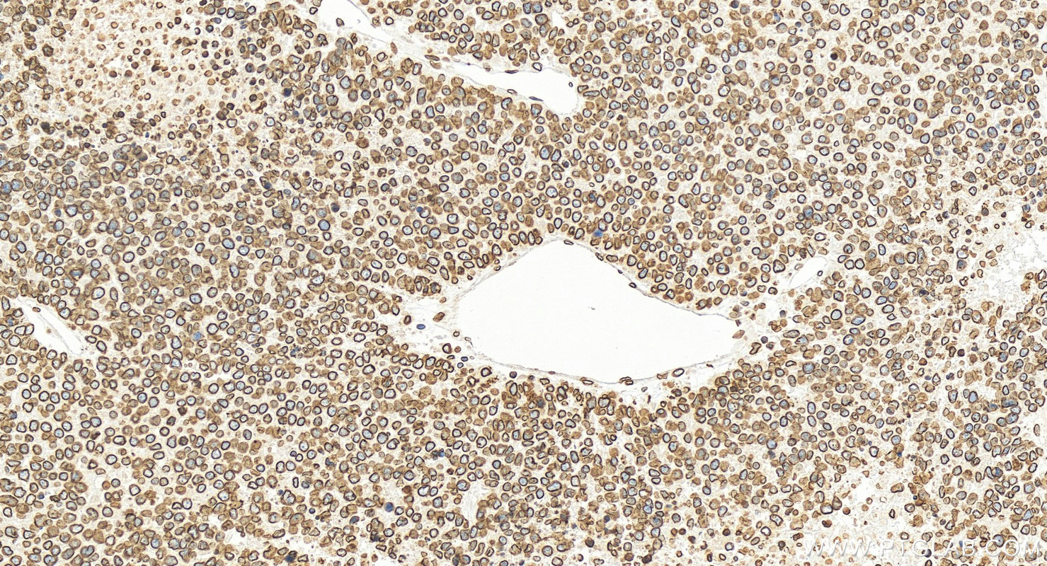 Immunohistochemistry (IHC) staining of human hepatocellular carcinoma using Lamin B1 Polyclonal antibody (12987-1-AP)