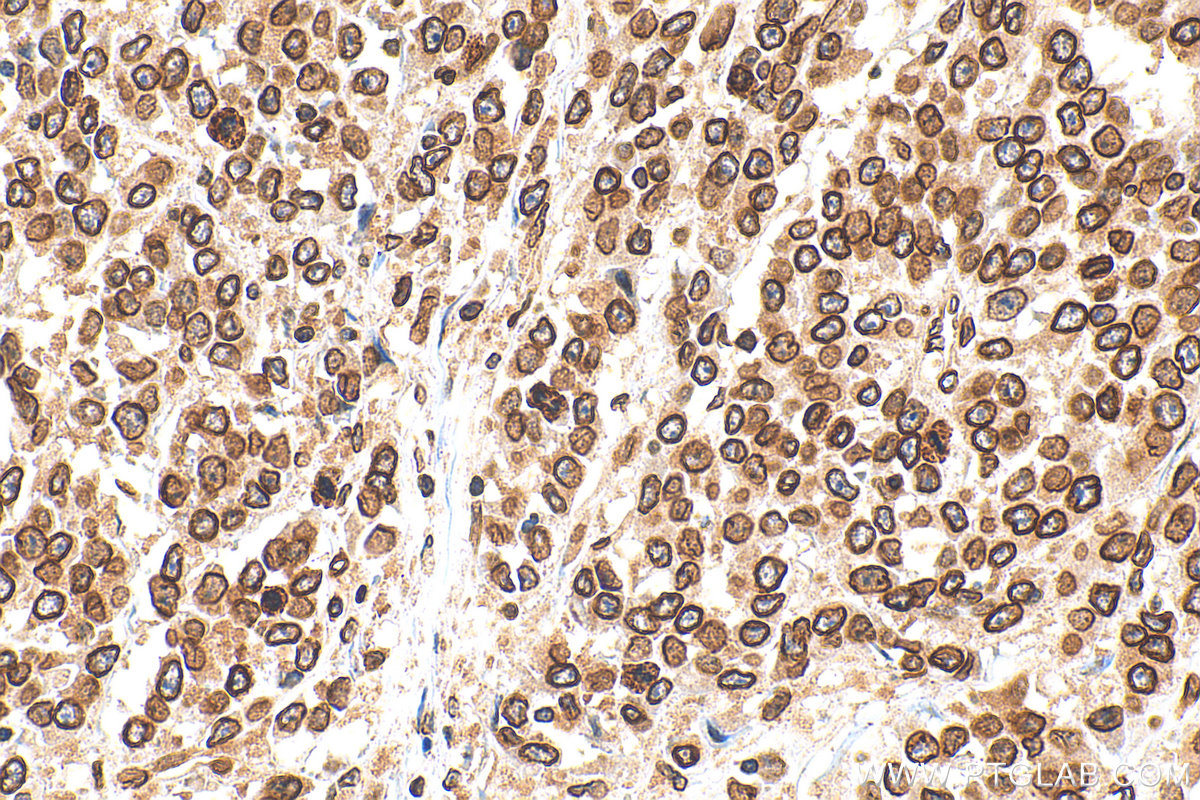 Immunohistochemistry (IHC) staining of human colon cancer tissue using Lamin B1 Polyclonal antibody (12987-1-AP)
