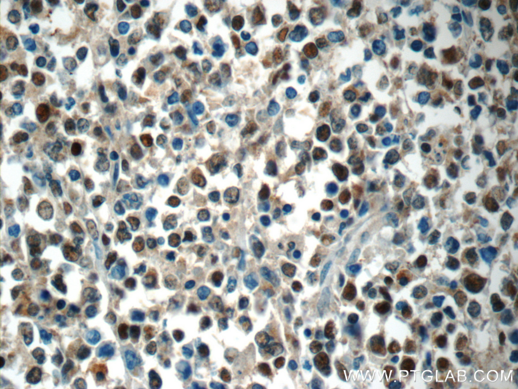 Immunohistochemistry (IHC) staining of human lymphoma tissue using MEF2BNB Polyclonal antibody (10931-1-AP)