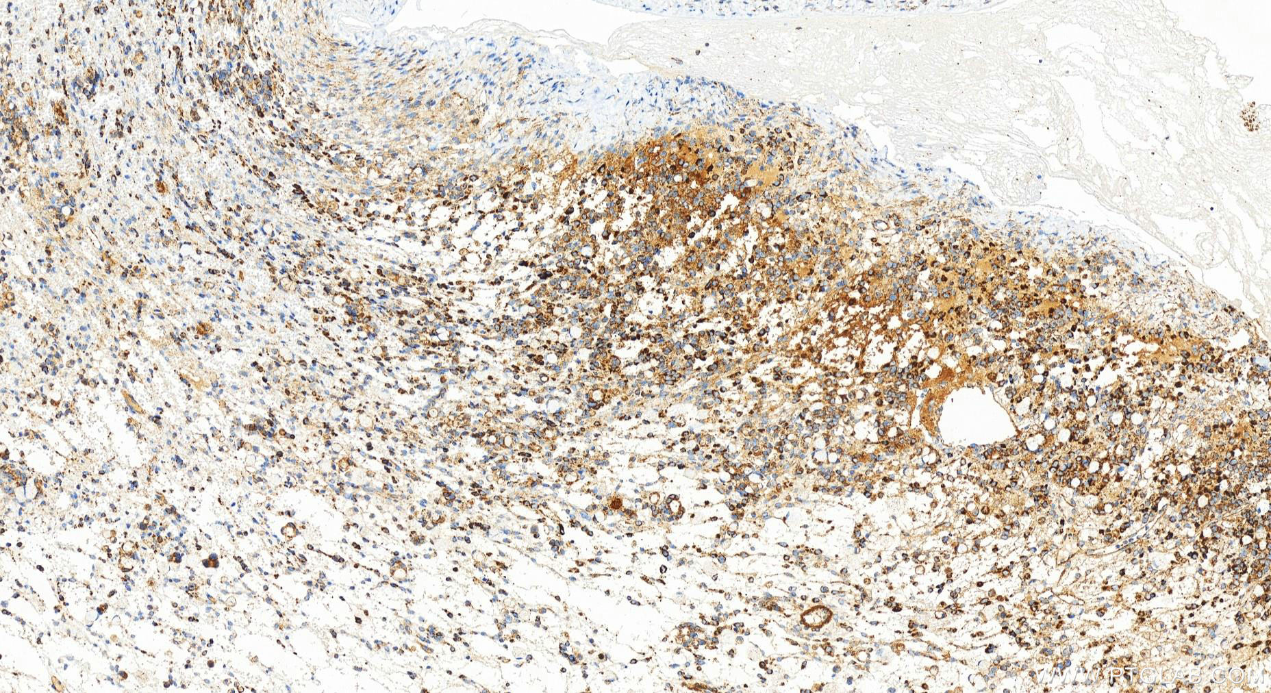 Immunohistochemistry (IHC) staining of human ovary cancer tissue using LONP1 Recombinant antibody (83552-2-RR)