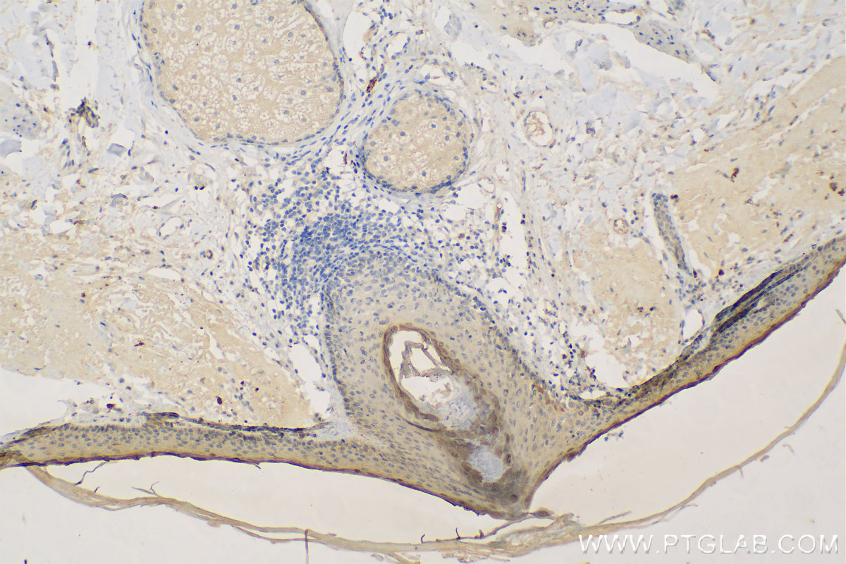 Immunohistochemistry (IHC) staining of human paracancerous tissue of skin using Loricrin Polyclonal antibody (55439-1-AP)