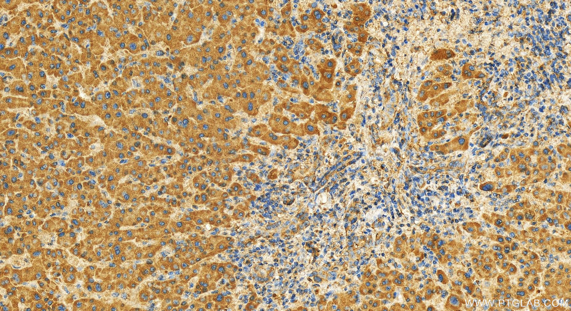 Immunohistochemistry (IHC) staining of human intrahepatic cholangiocarcinoma tissue using LPCAT4 Polyclonal antibody (17905-1-AP)