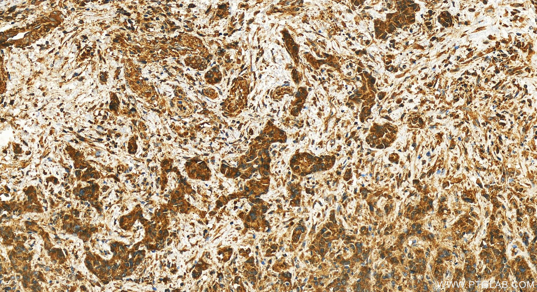 Immunohistochemistry (IHC) staining of human intrahepatic cholangiocarcinoma tissue using LPCAT4 Polyclonal antibody (17905-1-AP)