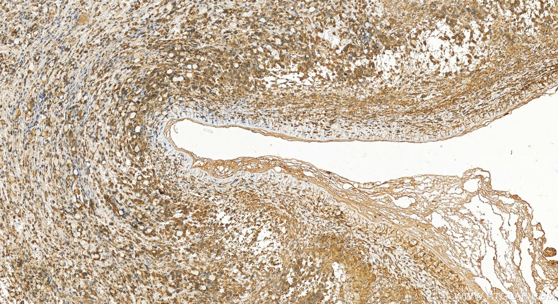 Immunohistochemistry (IHC) staining of human ovary cancer tissue using LPCAT4 Polyclonal antibody (17905-1-AP)