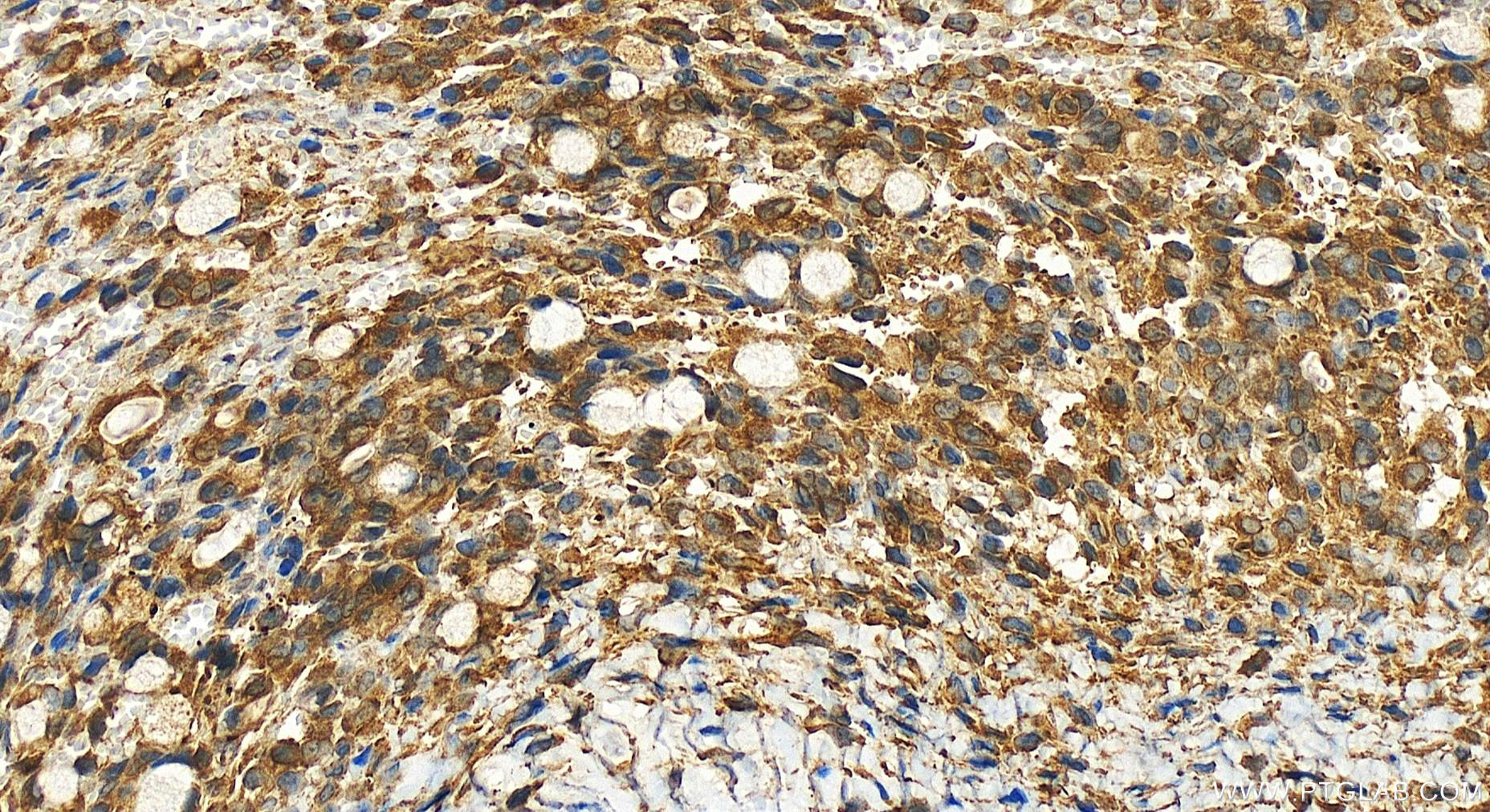 Immunohistochemistry (IHC) staining of human ovary cancer tissue using LPCAT4 Polyclonal antibody (17905-1-AP)