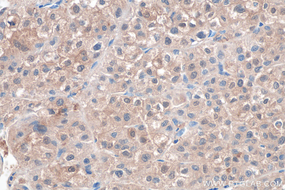 Immunohistochemistry (IHC) staining of human liver cancer tissue using LPPR2 Polyclonal antibody (25732-1-AP)