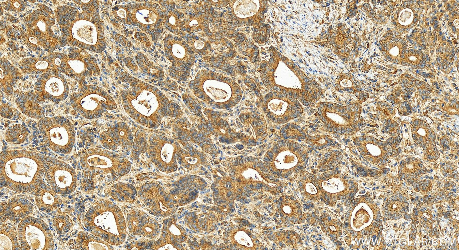 Immunohistochemistry (IHC) staining of human stomach cancer tissue using LRRC1 Polyclonal antibody (10128-2-AP)