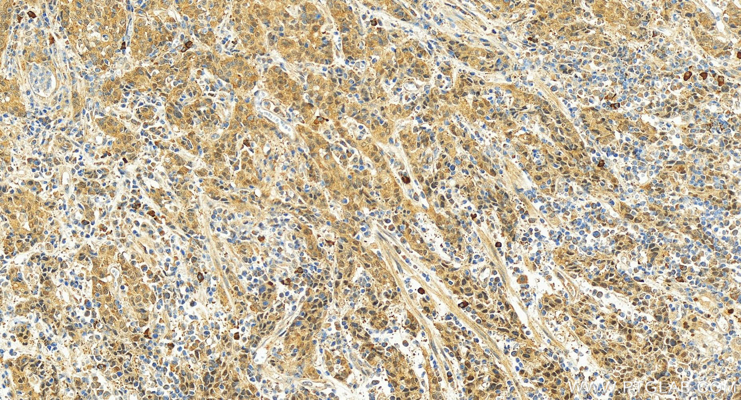 Immunohistochemistry (IHC) staining of human stomach cancer tissue using LRRC20 Polyclonal antibody (25562-1-AP)