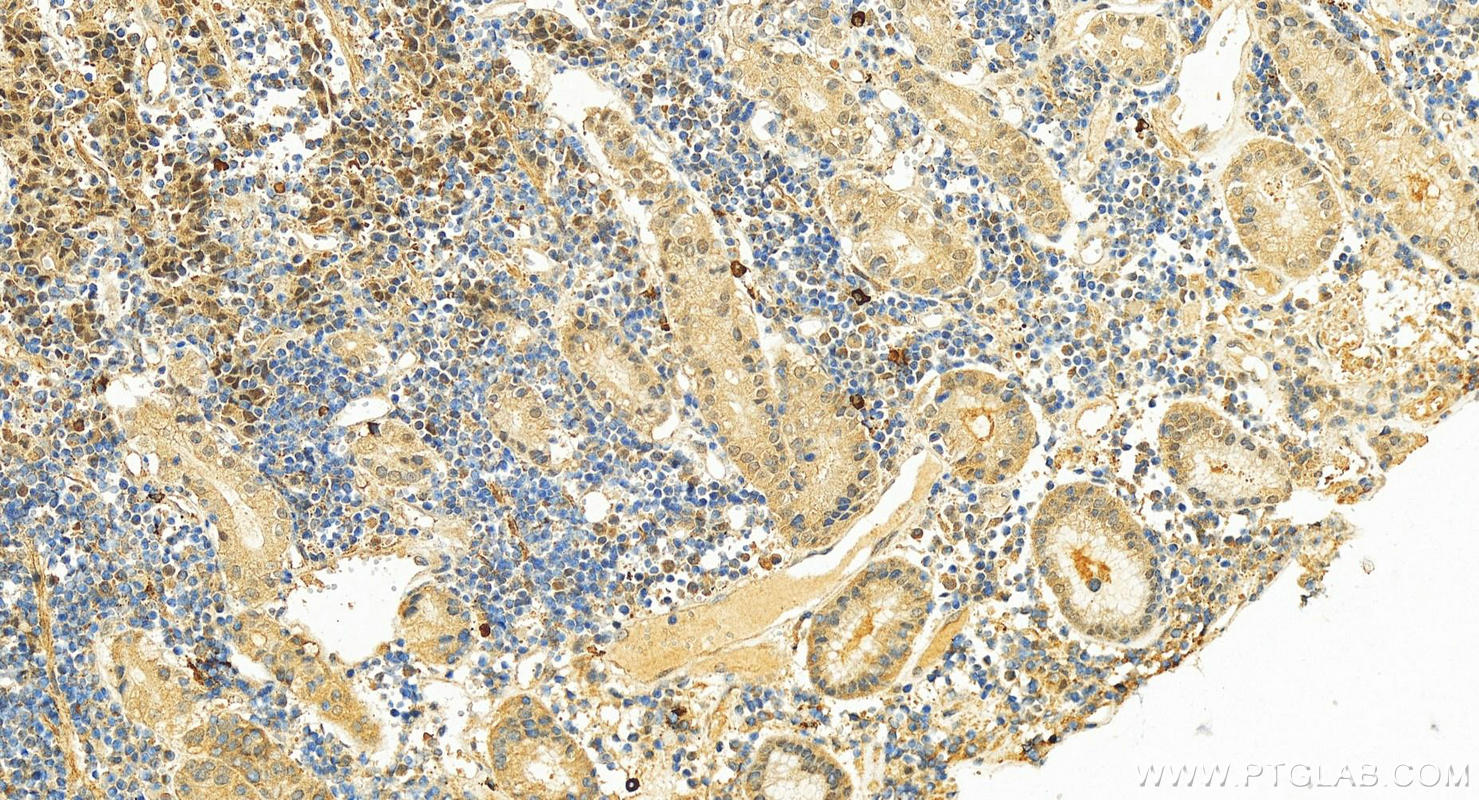 Immunohistochemistry (IHC) staining of human stomach cancer tissue using LRRC20 Polyclonal antibody (25562-1-AP)