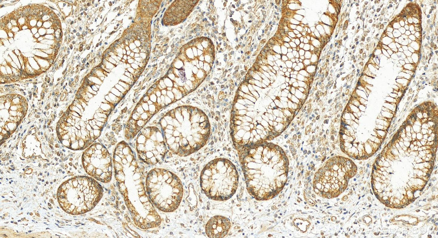 Immunohistochemistry (IHC) staining of human colon cancer tissue using LRRC8A/SWELL1 Polyclonal antibody (17155-1-AP)