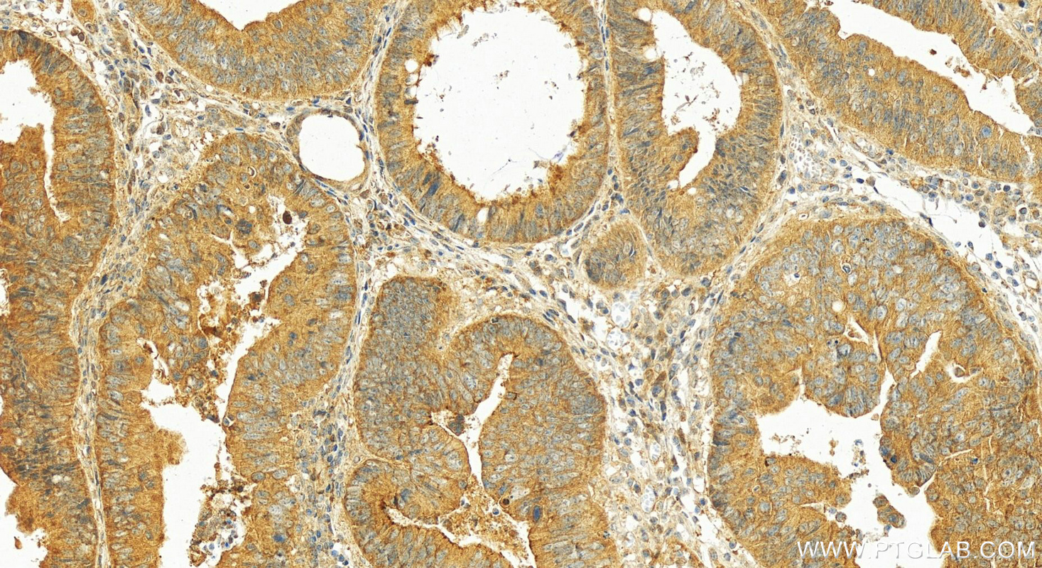 Immunohistochemistry (IHC) staining of human colon cancer tissue using LRRC8A/SWELL1 Polyclonal antibody (17155-1-AP)