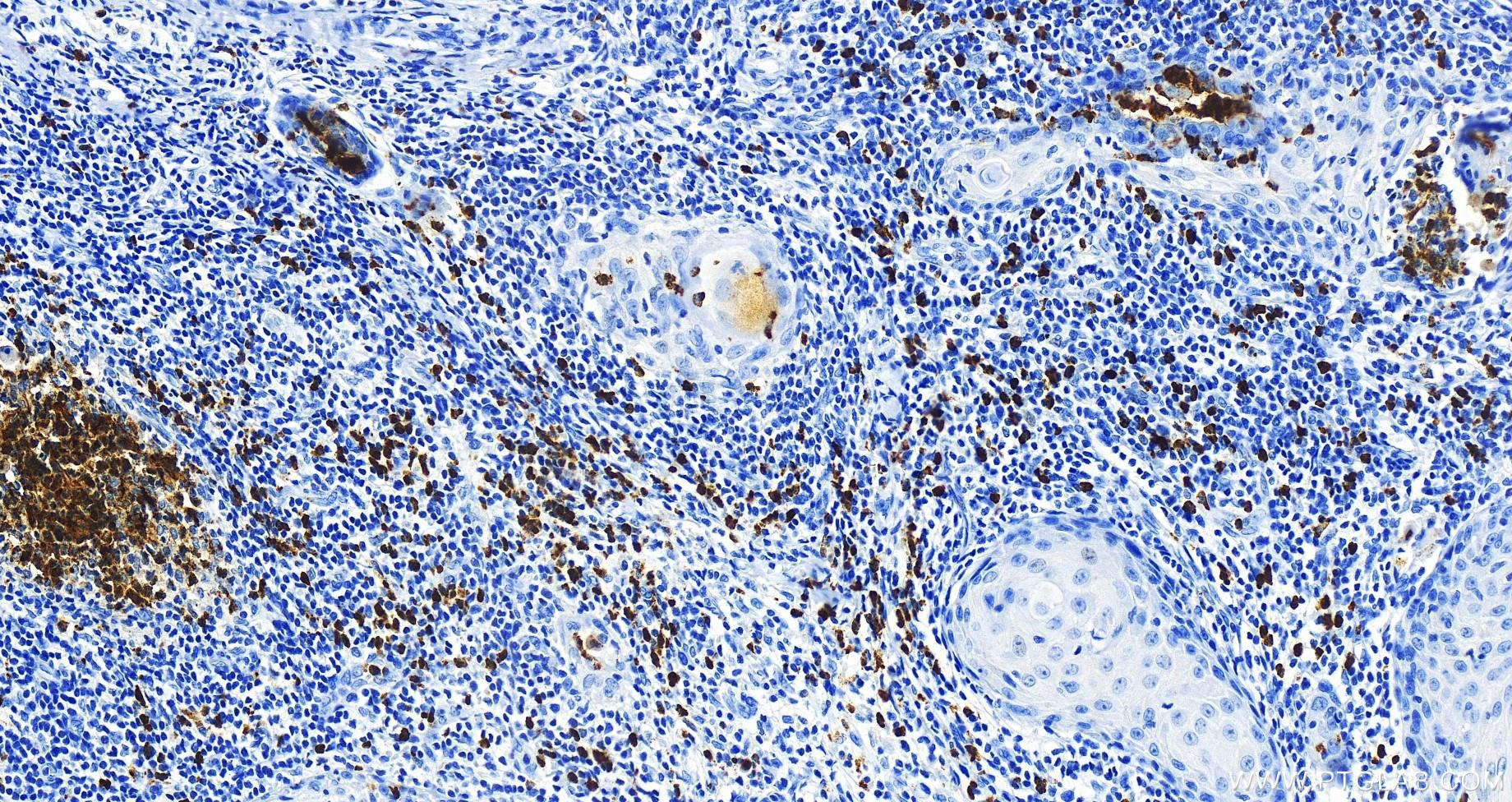 Immunohistochemistry (IHC) staining of human skin cancer tissue using LTF Monoclonal antibody (68509-1-Ig)