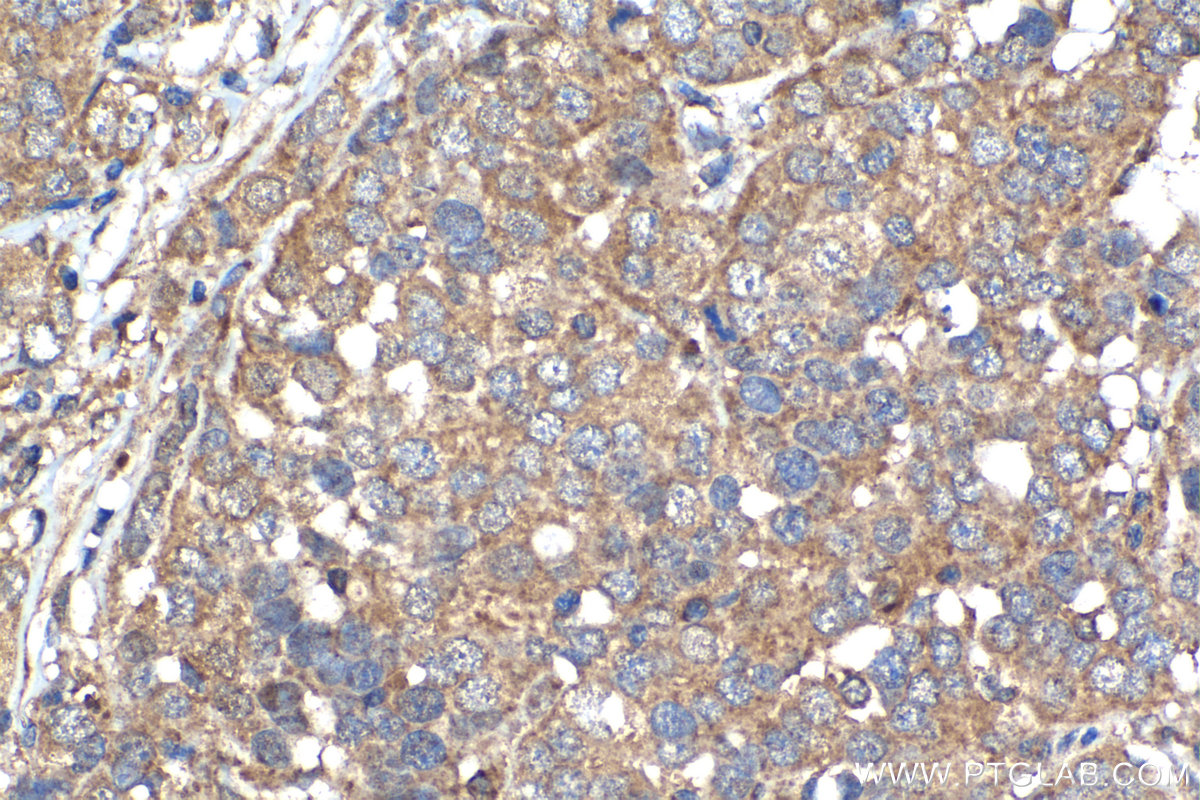 Immunohistochemistry (IHC) staining of human ovary tumor tissue using LUZP1 Polyclonal antibody (17483-1-AP)