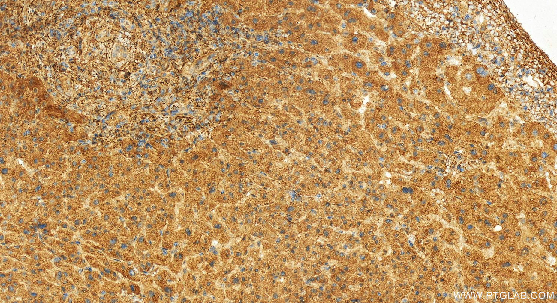 Immunohistochemistry (IHC) staining of human intrahepatic cholangiocarcinoma tissue using LXN Polyclonal antibody (13056-1-AP)