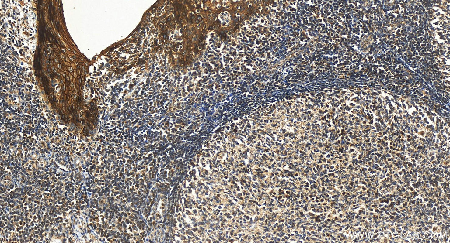 Immunohistochemistry (IHC) staining of human tonsillitis tissue using LY6D Polyclonal antibody (17361-1-AP)