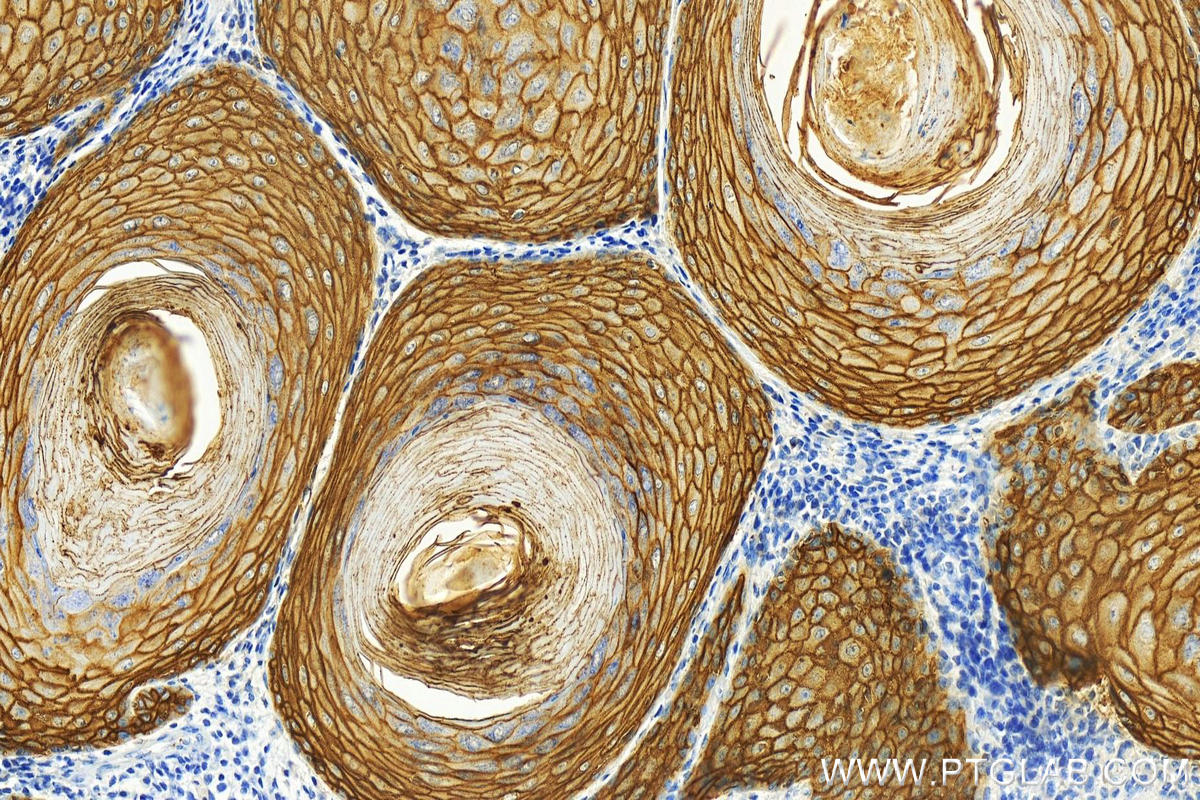 Immunohistochemistry (IHC) staining of human skin cancer tissue using LY6D Recombinant antibody (82094-1-RR)