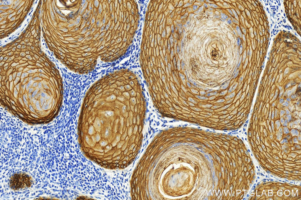 Immunohistochemistry (IHC) staining of human skin cancer tissue using LY6D Recombinant antibody (82094-1-RR)