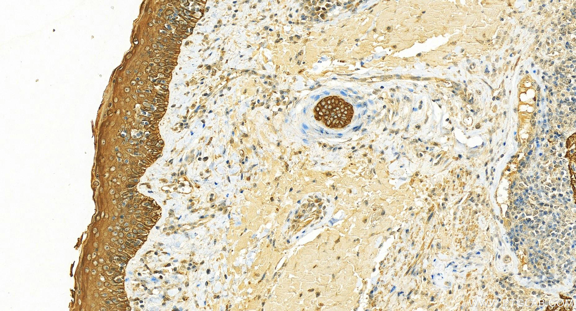 Immunohistochemistry (IHC) staining of human skin cancer tissue using LY6K Polyclonal antibody (12026-1-AP)