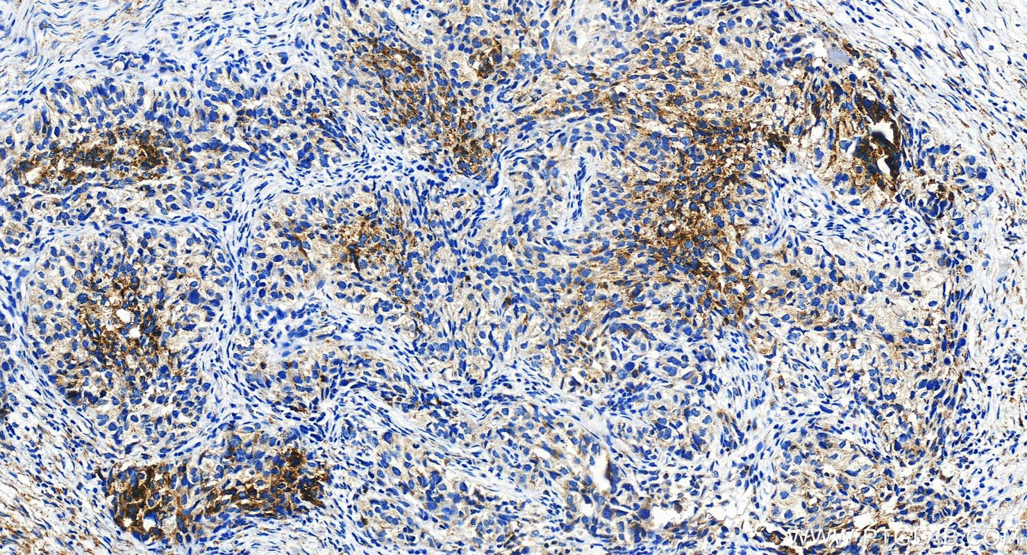 Immunohistochemistry (IHC) staining of human ovary cancer tissue using LYPD1 Polyclonal antibody (11415-1-AP)