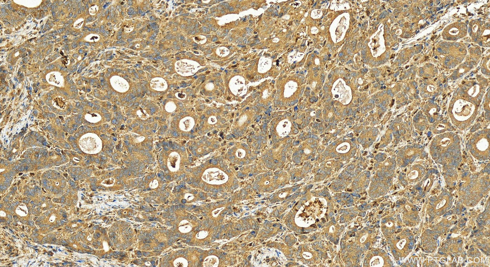 Immunohistochemistry (IHC) staining of human stomach cancer tissue using Lysozyme Polyclonal antibody (15013-1-AP)