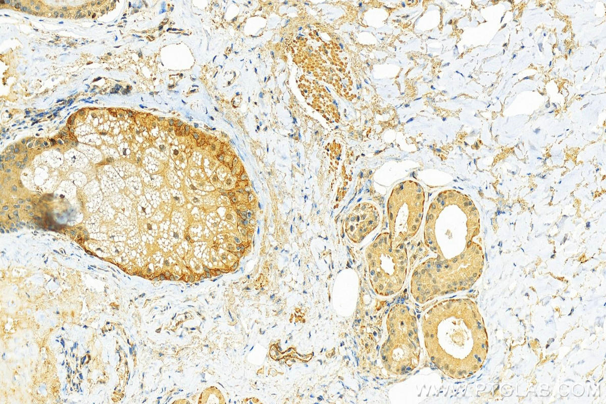 Immunohistochemistry (IHC) staining of human skin cancer tissue using LZTS1 Polyclonal antibody (20878-1-AP)