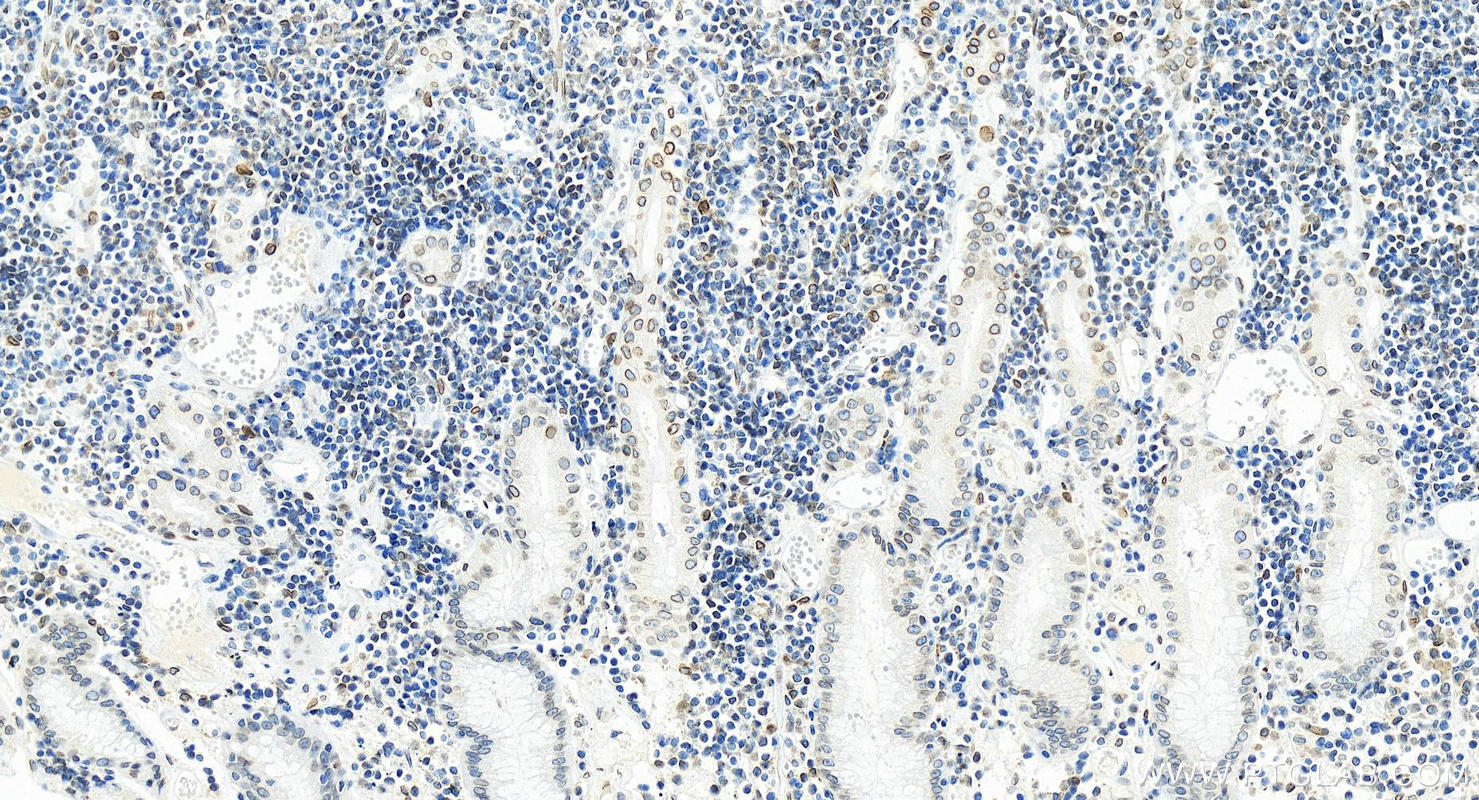 Immunohistochemistry (IHC) staining of human stomach cancer tissue using Lamin B2 Recombinant antibody (82801-2-RR)