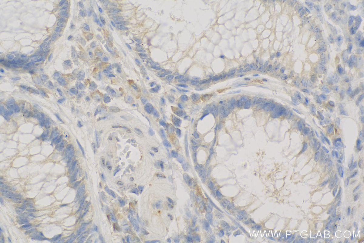 Immunohistochemistry (IHC) staining of Human Colon cancer tissue using MAB21L2 Polyclonal antibody (10971-1-AP)